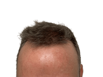 Hair Transplants Before & After Patient #2129