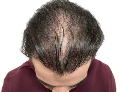 Hair Transplants Before & After Patient #2077