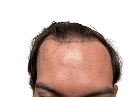 Hair Transplants Before & After Patient #2075