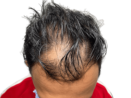 Hair Transplants Before & After Patient #2027