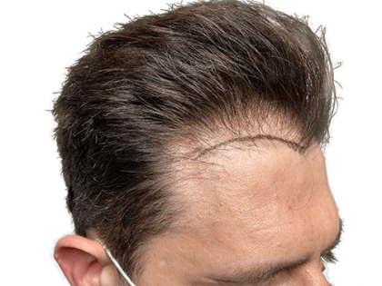 Hair Transplants Before & After Patient #2210