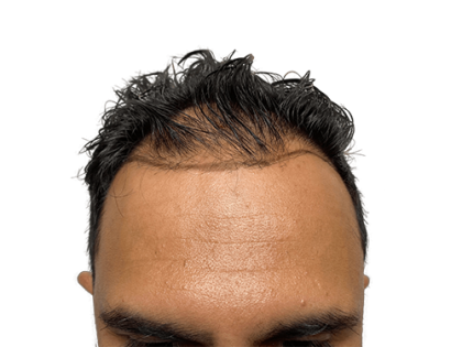 Hair Transplants Before & After Patient #2027