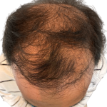 Hair Transplants Before & After Patient #2214