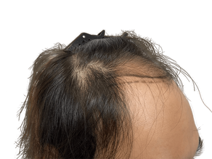 Hair Transplants Before & After Patient #2131