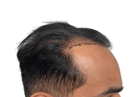 Hair Transplants Before & After Patient #2126