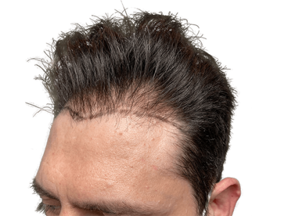 Hair Transplants Before & After Patient #2210