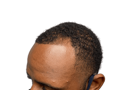 Hair Transplants Before & After Patient #2127