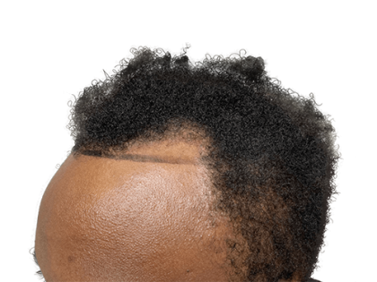 Male Breast Surgery Before & After Photos