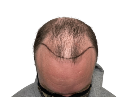 Hair Transplants Before & After Patient #2132