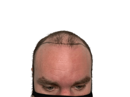 Patient #2132 Hair Transplants Before and After Photos Austin - Plastic