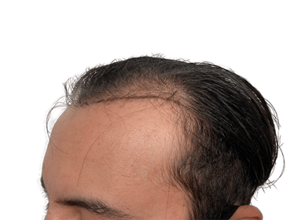 Hair Transplants Before & After Patient #2128