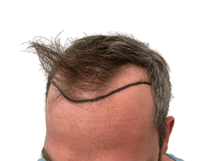 Topical Testosterone Gel � Restore Hormone Balance & Vitality