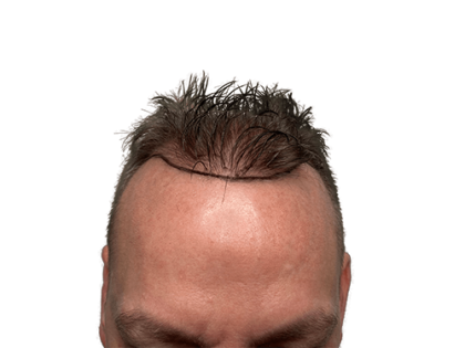 Hair Transplants Before & After Patient #2129