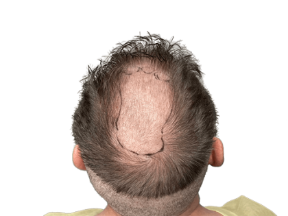 Hair Transplants Before & After Patient #2129