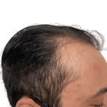Hair Transplants Before & After Patient #2128