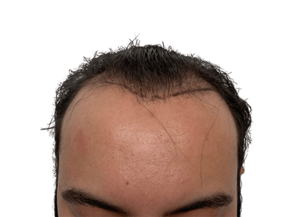 Patient #2128 Hair Transplants Before and After Photos Austin - Plastic