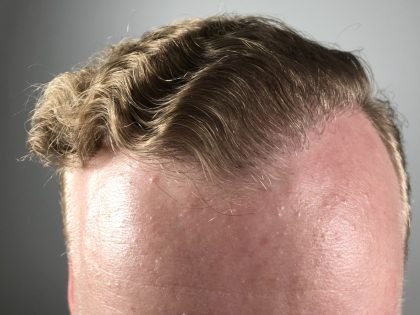 Hair Transplants Before & After Patient #2826