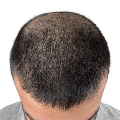 Hair Transplants Before & After Patient #3541
