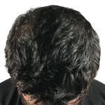 Hair Transplants Before & After Patient #3541