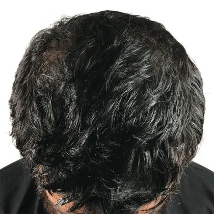 Hair Transplants Before & After Patient #3541