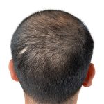 Hair Transplants Before & After Patient #3541