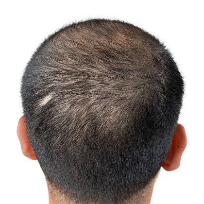 Hair Transplants Before & After Patient #3541