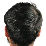 Hair Transplants Before & After Patient #3541