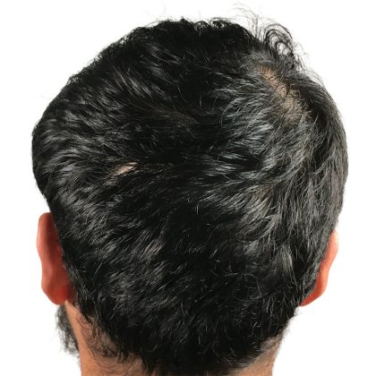 Hair Transplants Before & After Patient #3541