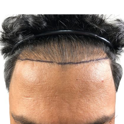 Hair Transplants Before & After Patient #3549