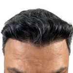 Hair Transplants Before & After Patient #3549
