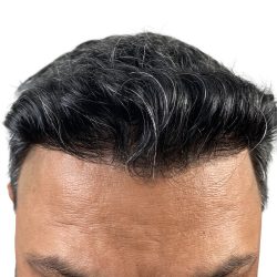Hair Transplants Before & After Patient #3549