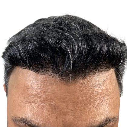 Hair Transplants Before & After Patient #3549