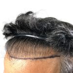 Hair Transplants Before & After Patient #3549