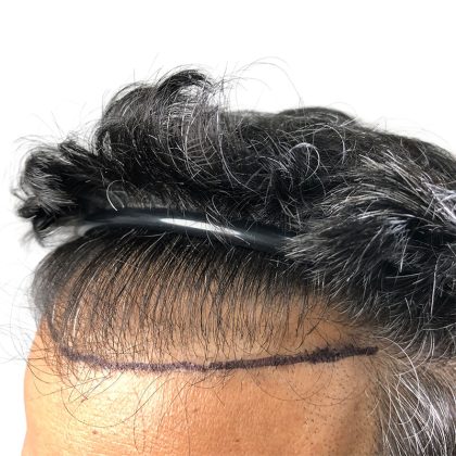 Hair Transplants Before & After Patient #3549