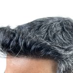Hair Transplants Before & After Patient #3549
