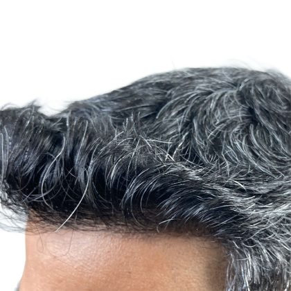 Hair Transplants Before & After Patient #3549