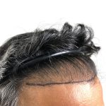 Hair Transplants Before & After Patient #3549