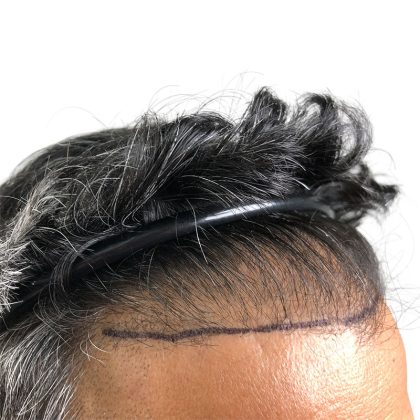 Hair Transplants Before & After Patient #3549
