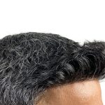 Hair Transplants Before & After Patient #3549