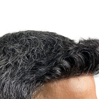 Hair Transplants Before & After Patient #3549
