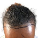 Hair Transplants Before & After Patient #3550