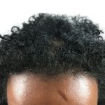 Hair Transplants Before & After Patient #3550