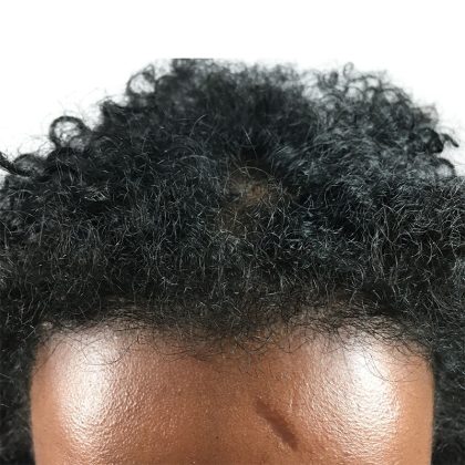 Hair Transplants Before & After Patient #3550