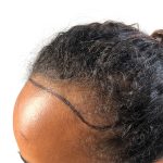 Hair Transplants Before & After Patient #3550