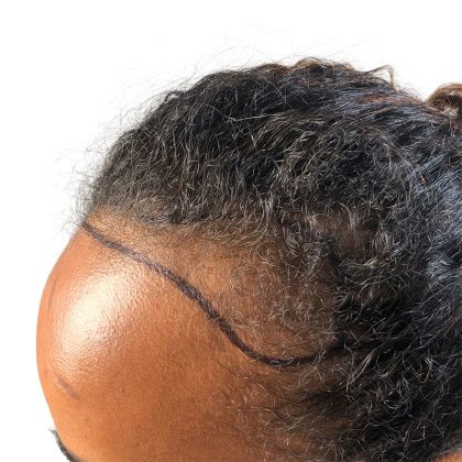 Hair Transplants Before & After Patient #3550
