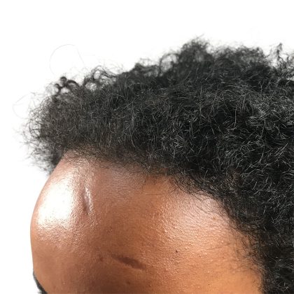 Hair Transplants Before & After Patient #3550