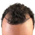 Hair Transplants Before & After Patient #3551