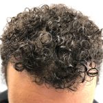 Hair Transplants Before & After Patient #3551