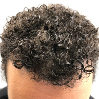 Hair Transplants Before & After Patient #3551