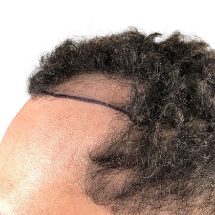 Hair Transplants Before & After Patient #3551